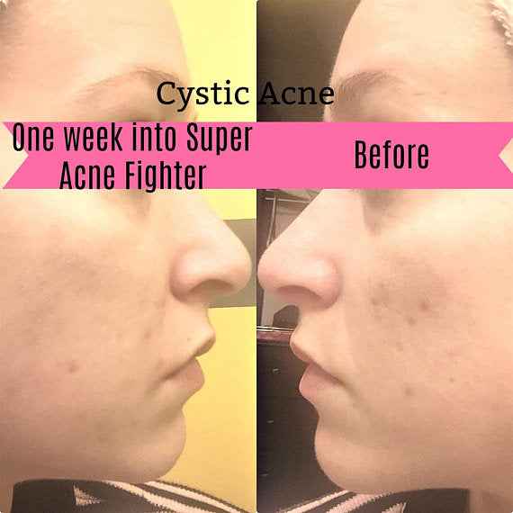 Super Acne Fighter - Organic Acne Treatment Serum for Clear Skin